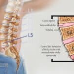 A person holding the lower back beside a side-view drawing of a central L5-S1 disc herniation pressing on the nerve roots