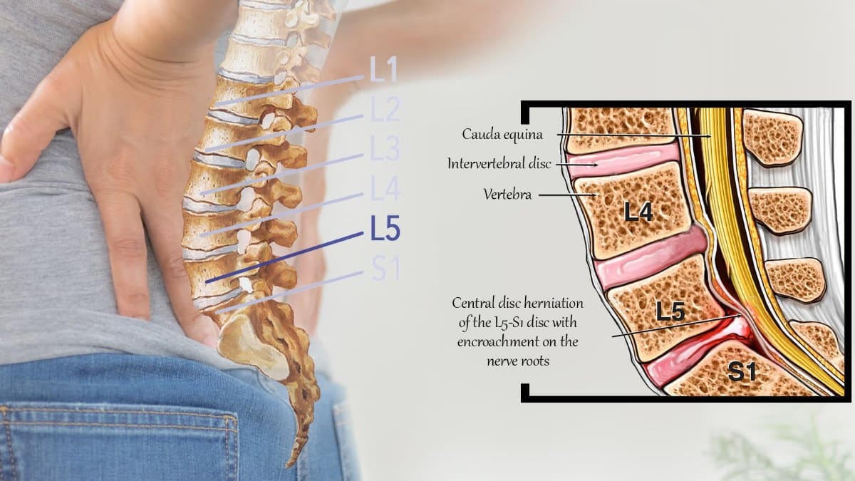 You are currently viewing L5-S1 Disc Bulge & Herniation: Symptoms, Causes and Care
