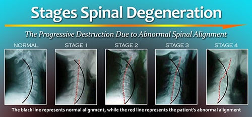 infographic on neck pain causes and degrative phases of neck problems caused by cervical spondylosis and disc degeneration