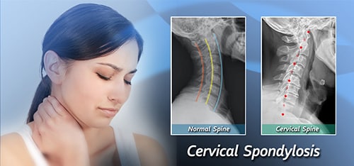 female with neck discomfort with -Xray of neck showing normal neck and cervical spondylosis