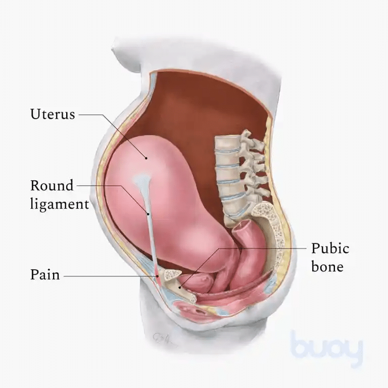 A medical illustration showing the human anatomy of a pregnant woman from the side and it shows labels which mark the uterus, pubic bone, and round ligament pain area which will need a professional chiropractor to help and care for this issue.
