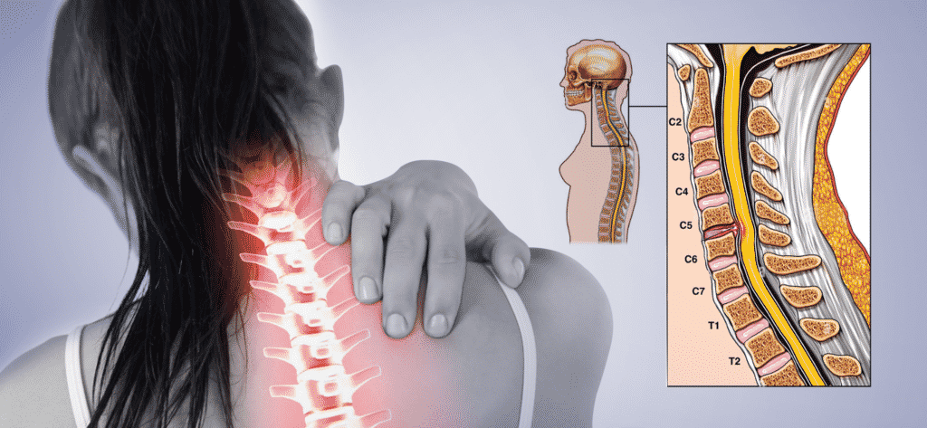 Women with C5-C6 neck pain and illustration of neck bone