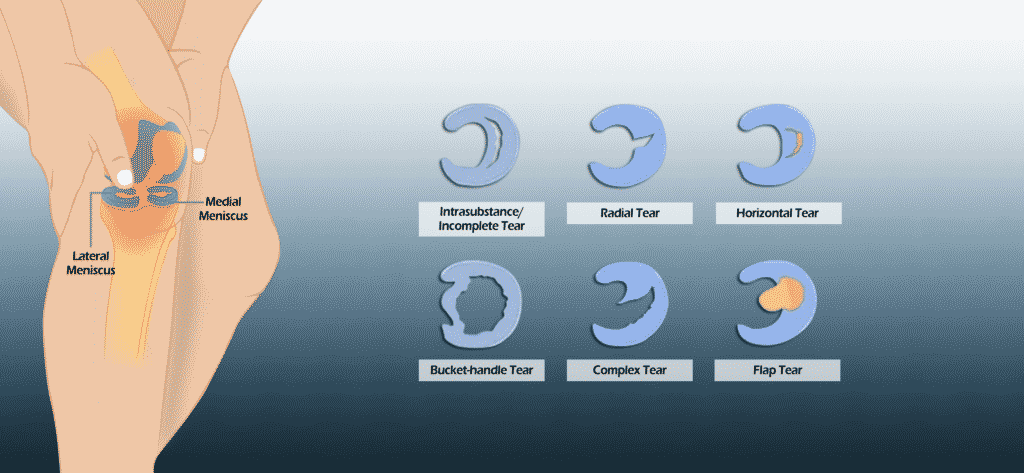 Meniscus Tear Infographic