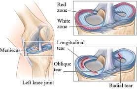 A medical illustration of a human knee and a top down cross section of the bottom knee joint.
