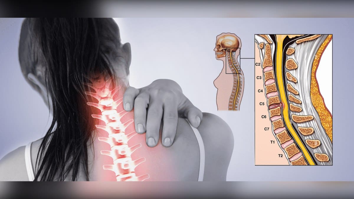 You are currently viewing C5-C6 Spine: Disc Bulge Symptoms, Nerves and Treatment