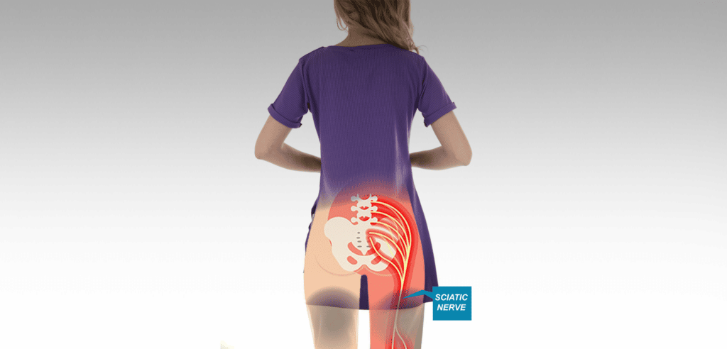 Sciatica Management in KL: Non-Surgical Care