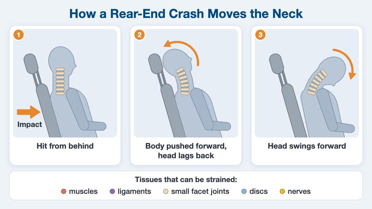 Read more about the article Whiplash Neck Injury: Symptoms, Grades and Treatment in KL