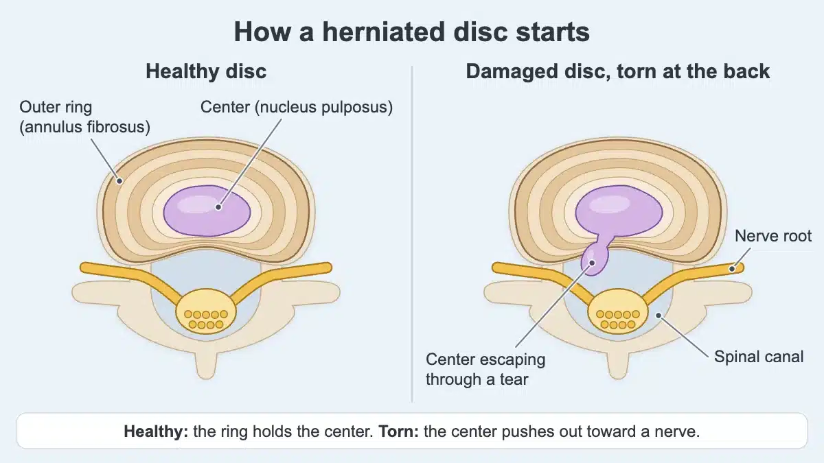 Two lower back discs seen from above: on the left a healthy disc whose outer ring holds the center; on the right a damaged disc whose center escapes through a tear at the back toward a nerve root