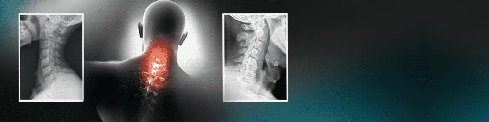 Neck pain illustration: a figure seen from behind with the neck vertebrae glowing red, between two side-view X-rays of the cervical spine