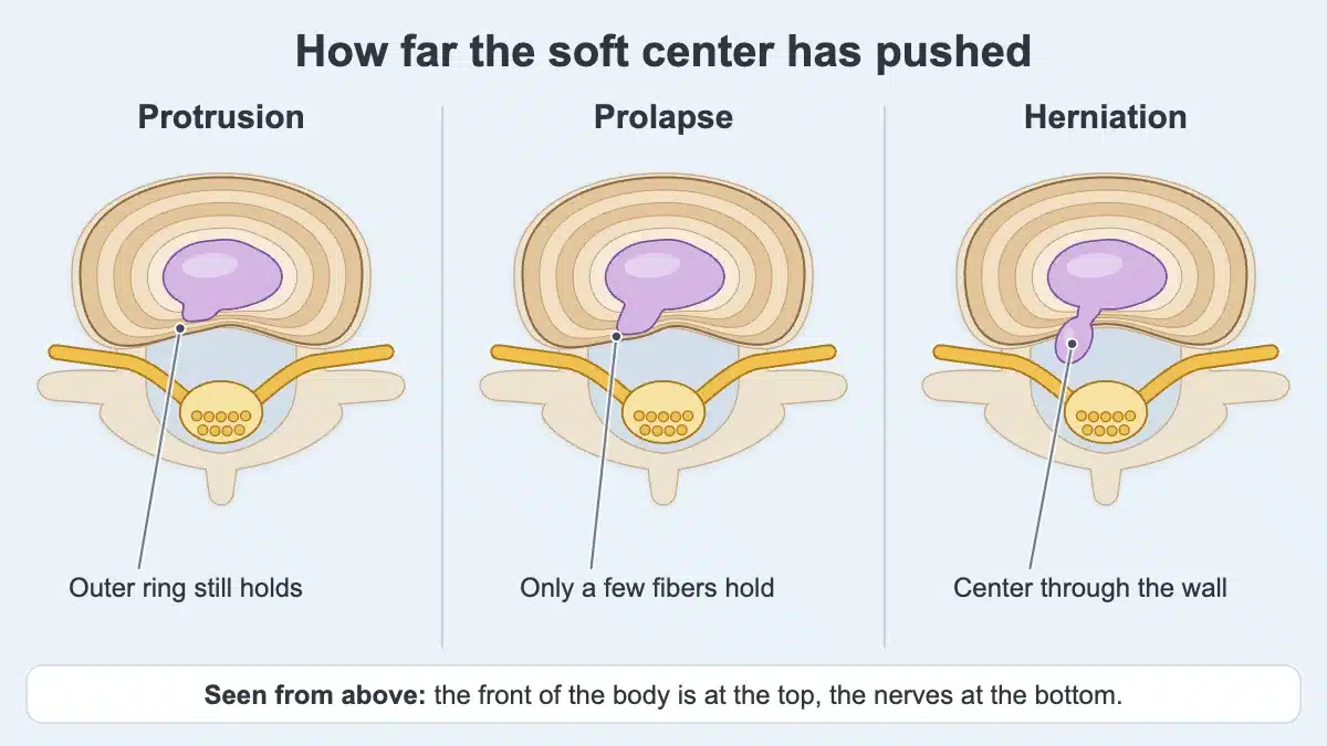 Three lower back discs seen from above: a protrusion whose outer ring still holds, a prolapse held in by its last few outer fibers, and a herniation whose center has broken through toward a nerve root