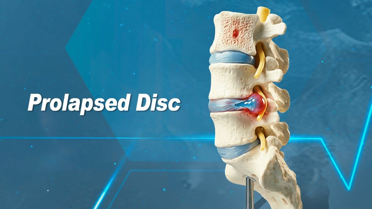 Spine model with a prolapsed disc at a lower back level, its center pressing out toward a nerve root, labeled Prolapsed Disc